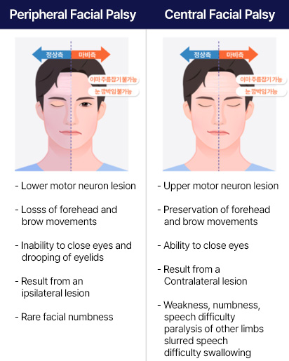 facil-palsy
